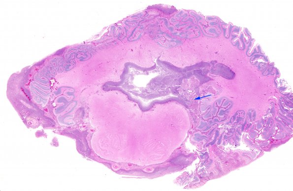 1D3 Ventriculitis (Case 1) 1 copy A