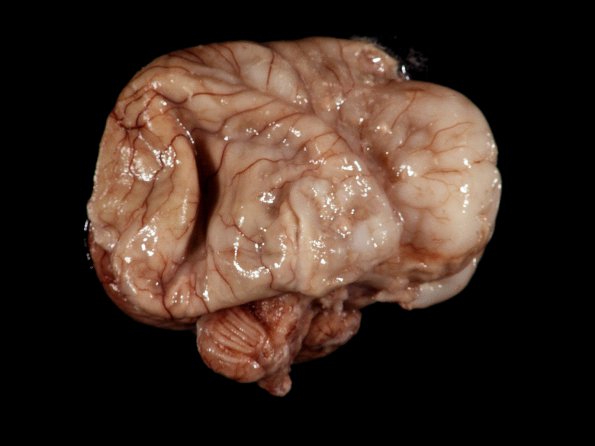 2A1 Hydrocephalus, Meningitis, abscess (Case 2) 1