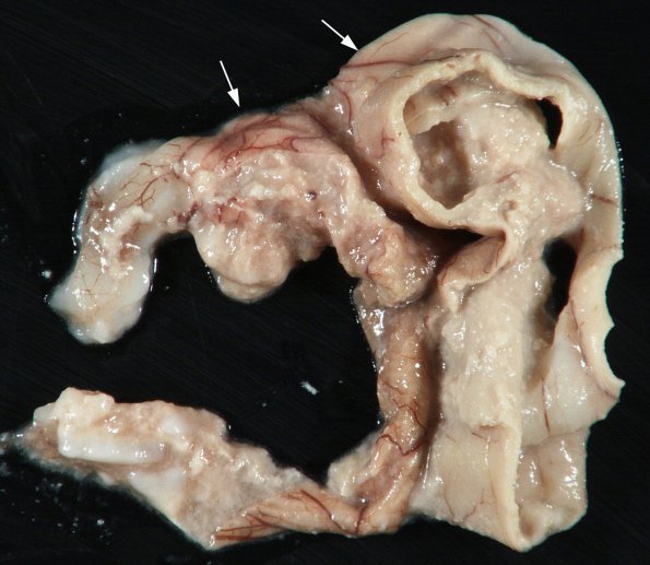 2A2 Hydrocephalus, Meningitis, abscess (Case 2) 3 copy