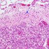 2B1 Hypoxia-Ischemia & Meningitis & Abscess & Hydrocephalus (Case 2) N6 H&E 2 copy