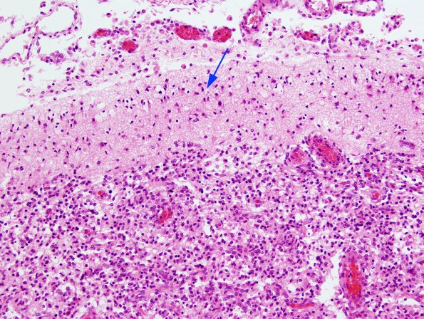 2B1 Hypoxia-Ischemia & Meningitis & Abscess & Hydrocephalus (Case 2) N6 H&E 2 copy