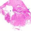 2D1 Hypoxia-Ischemia & Meningitis & Abscess & Hydrocephalus (Case 2) H&E N8 1 copy