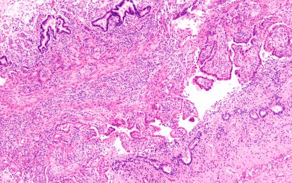 2D10 Meningitis, bacterial (Case 2) SAS involvement with hydrocephalus N9 H&E 4