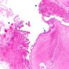 2D2 Hypoxia-Ischemia & Meningitis & Abscess & Hydrocephalus (Case 2) H&E N8 3 copy