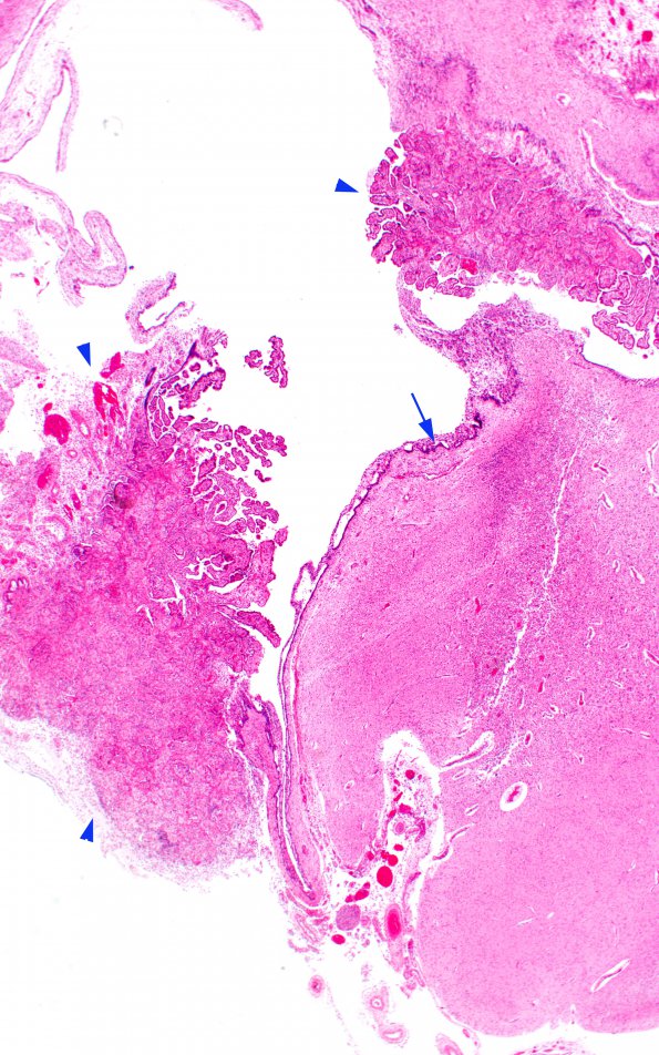 2D2 Hypoxia-Ischemia & Meningitis & Abscess & Hydrocephalus (Case 2) H&E N8 3 copy