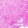 2D3 Hypoxia-Ischemia & Meningitis & Abscess & Hydrocephalus (Case 2) H&E N8 5