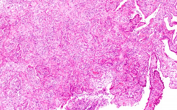 2D3 Hypoxia-Ischemia & Meningitis & Abscess & Hydrocephalus (Case 2) H&E N8 5