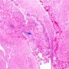 2D4 Hypoxia-Ischemia & Meningitis & Abscess & Hydrocephalus (Case 2) H&E N8 6 copy