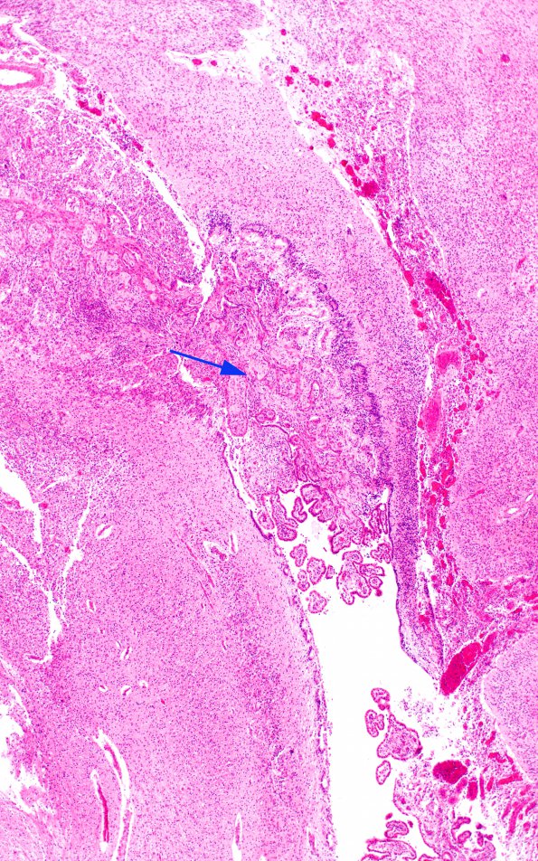 2D4 Hypoxia-Ischemia & Meningitis & Abscess & Hydrocephalus (Case 2) H&E N8 6 copy