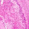 2D5 Hypoxia-Ischemia + Meningitis & Abscess & Hydrocephalus (Case 2) H&E N8 4