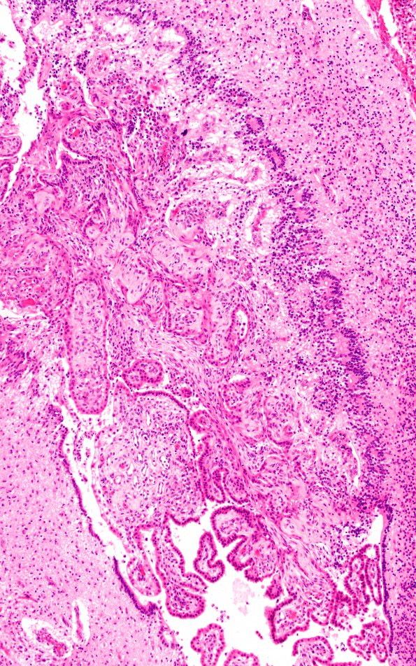 2D5 Hypoxia-Ischemia + Meningitis & Abscess & Hydrocephalus (Case 2) H&E N8 4