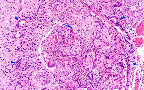 2D6 Meningitis, bacterial (Case 2) SAS involvement with hydrocephalus N9 H&E 2 copy