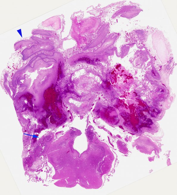 2D7 Meningitis, bacterial (Case 2) SAS involvement with hydrocephalus N9 H&E copy copy