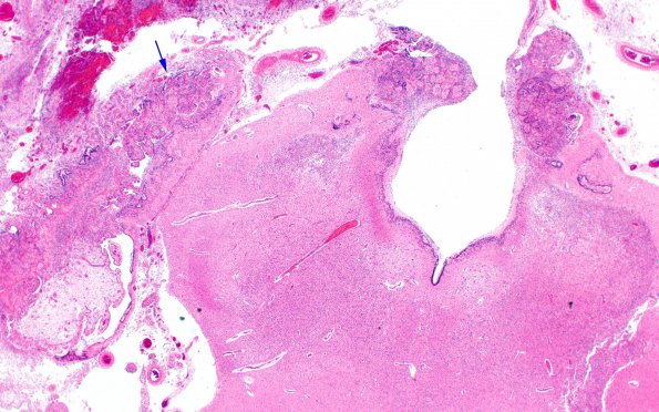 2D8 Meningitis, bacterial (Case 2) SAS involvement with hydrocephalus N9 H&E 6 copy