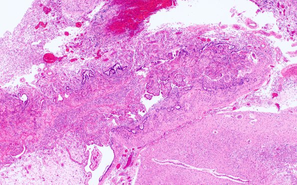 2D9 Meningitis, bacterial (Case 2) SAS involvement with hydrocephalus N9 H&E 3