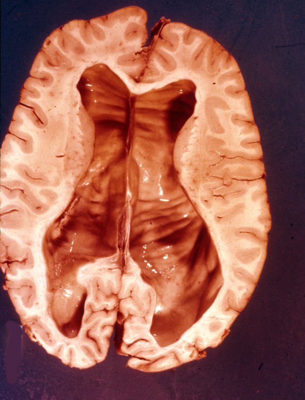 3 Meningitis Hydrocephalus (Case 3) gross 1