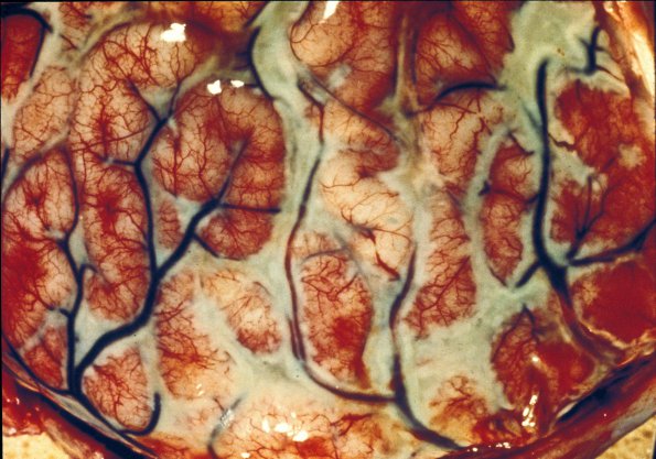 1 Meningitis, bacterial (Case 1)