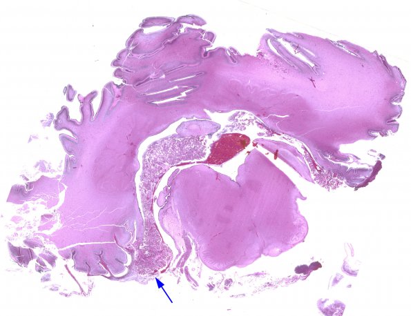 10A1 Meningitis, bacterial (E Coli) (Case 10) H&E whole mount copy