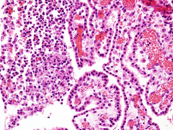 10A2 Meningitis, bacterial (E Coli) (Case 10) H&E 1