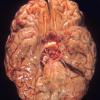 11A1 Meningitis, streptococcus (Case 5) 1A