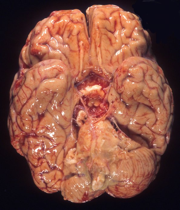 11A1 Meningitis, streptococcus (Case 5) 1A
