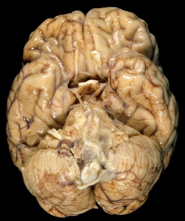 11A2 Meningitis, streptococcus (Case 5) 3A