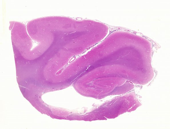 11B Meningitis (Case 5) Cortex N3 WM H&E A