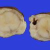 11C Meningitis, streptococcus (Case 5) 4 best A