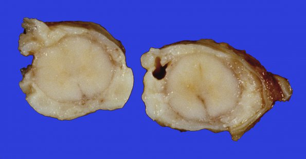 11C Meningitis, streptococcus (Case 5) 4 best A