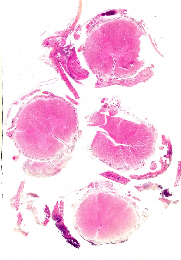 11D1 Meningitis (Case 5) Spinal cord WM A