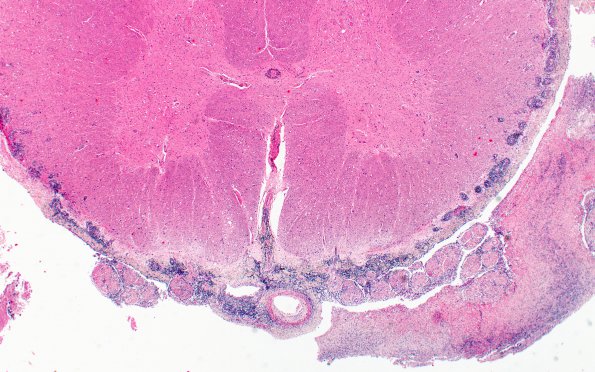 11D2 Meningitis (Case 5) Spinal cord 2X A