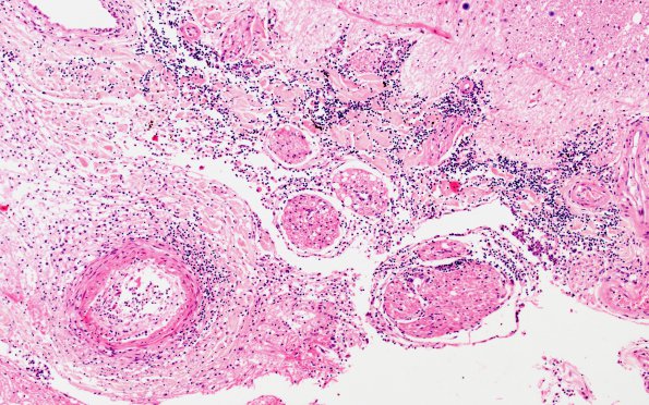 11D3 Meningitis (Case 5) Spinal cord WM 10X A