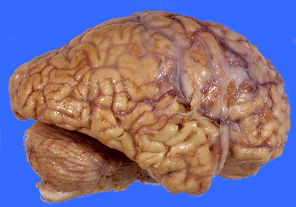 2 Meningitis, pneumococcus (Case 2) 2