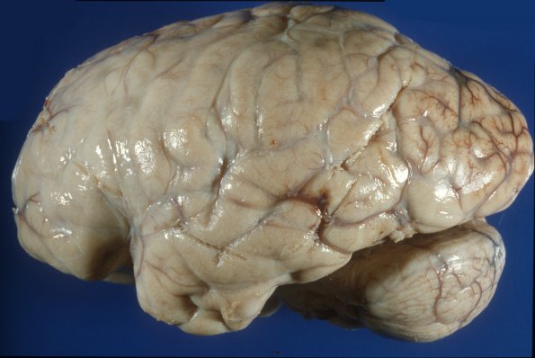 3A1 Meningitis, Strep Pneumoniae (Case 3) 1