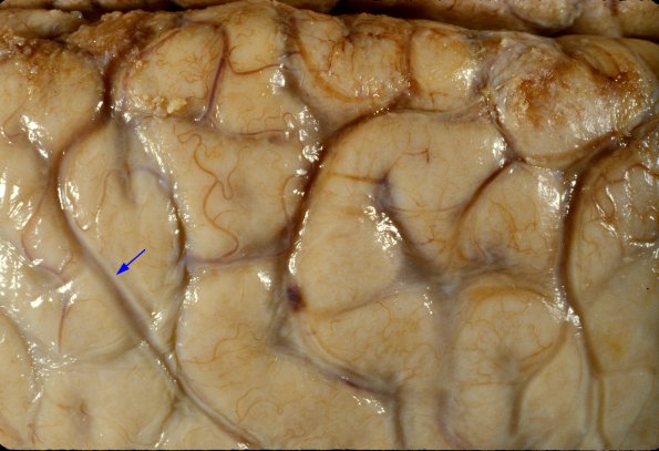 3A2 Meningitis, bacterial (Case 3) 2 copy