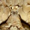 3A3 Meningitis, bacterial (Case 3) 1