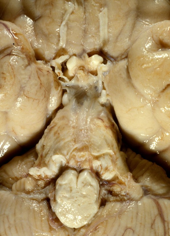 3A3 Meningitis, bacterial (Case 3) 1