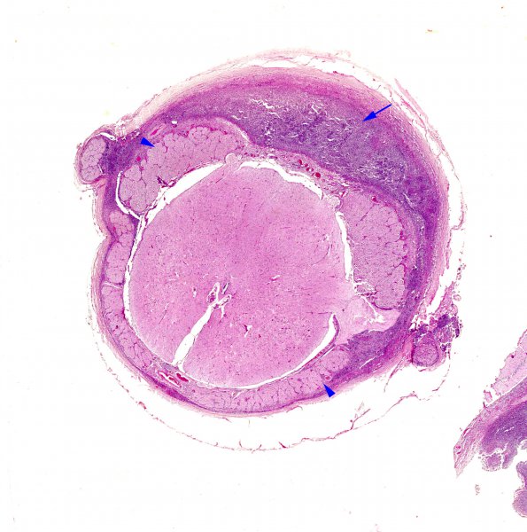 4B Meningitis, bacterial (Case 4) H&E spinal cord 2X copy