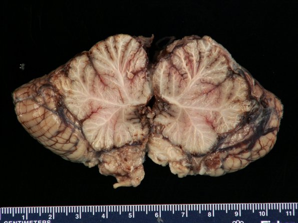 5A Meningitis, Klebsiella (Case 8) Gross_15