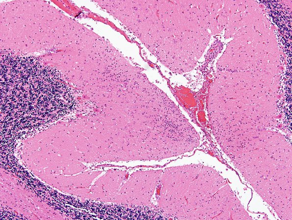 5B1 Meningitis, Klebsiella (Case 8) H&E 1