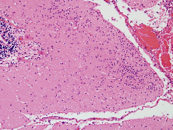 5B2 Meningitis, Klebsiella (Case 8) H&E 2