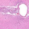 5C Meningitis, Klebsiella (Case 8) H&E 4