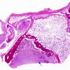 5E1 Meningitis, Klebsiella, (Case 8) sphenoid sinus H&E whole mount copy