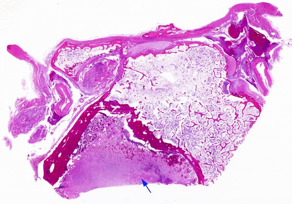 5E1 Meningitis, Klebsiella, (Case 8) sphenoid sinus H&E whole mount copy