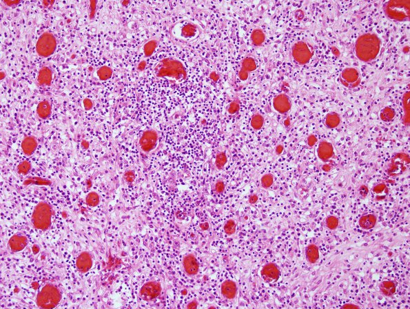 5E2 Meningitis, Klebsiella, sphenoid sinus H&E 2