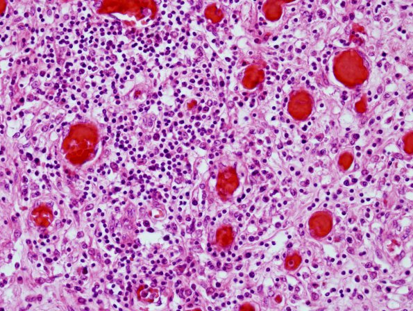 5E3 Meningitis, Klebsiella, (Case 8) sphenoid sinus H&E 3