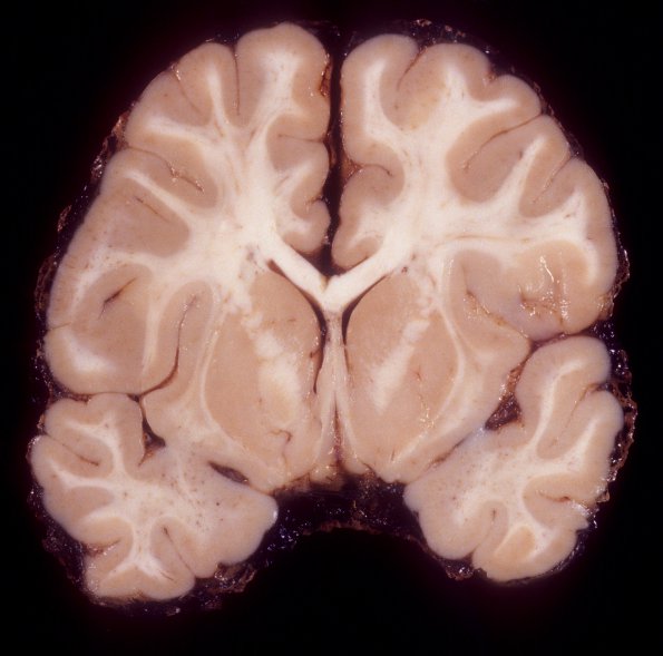 6A1 Meningitis, Meningococcus & Edema (Case 9)