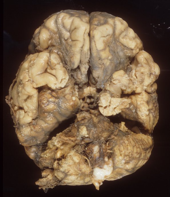 7A1 Meningitis, ependymitis, choroid plexitis (Case 6) 3