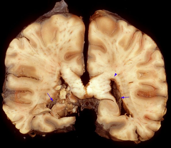 7A2 Meningitis, ependymitis, choroid plexitis (Case 6) 2 copy