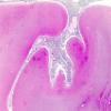 7B1 Meningitis (Case 6) 2